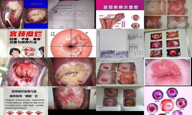 宫颈糜烂价格费用 - 汕头宫颈糜烂的症状