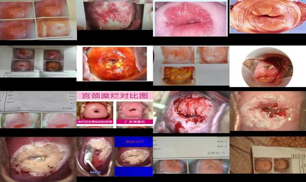 宫颈糜烂价钱是多少 - 汕头宫颈糜烂图片