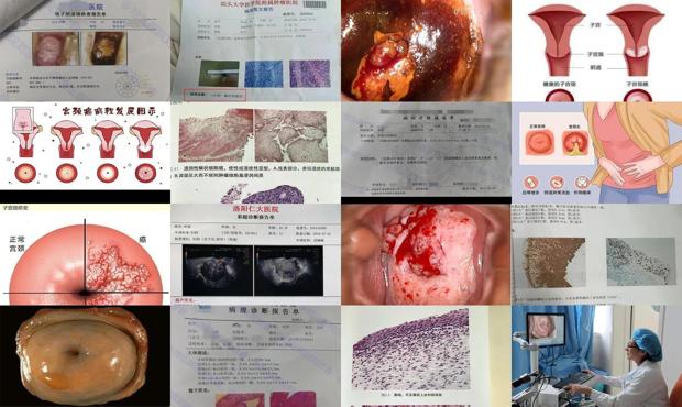 宫颈病变病 - 汕头宫颈病变