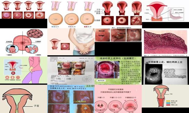 柱状宫颈图片 - 汕头宫颈柱状上皮异位