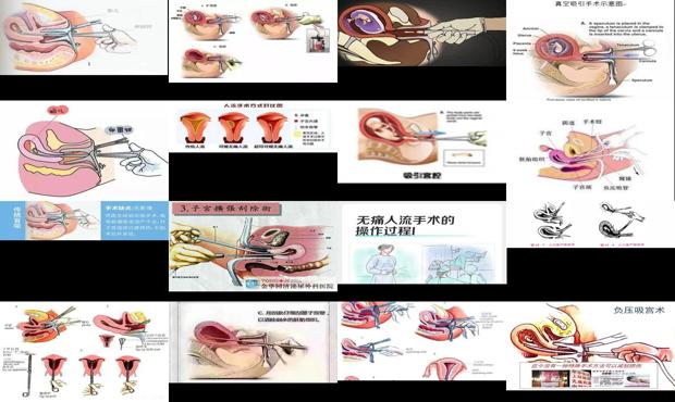 汕头*人流手术过程图解