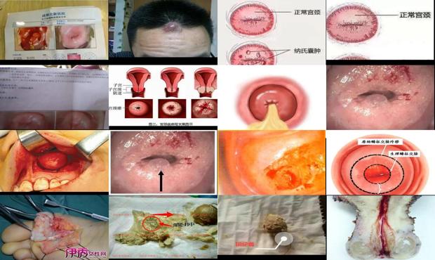 宫颈纳氏囊肿可怕吗 - 汕头宫颈纳氏囊肿