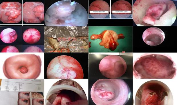 宫颈息肉 图 - 汕头宫颈息肉图片