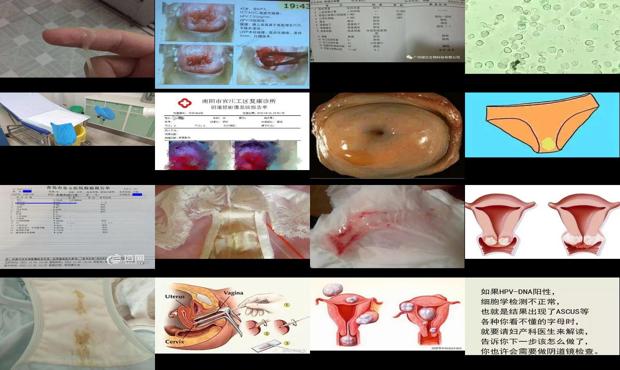 汕头宫颈分泌物检查