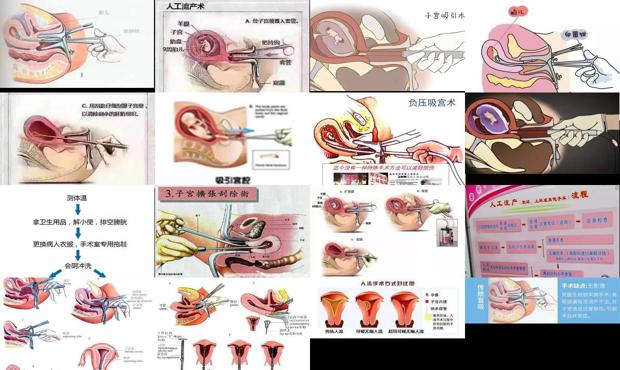 澄海无痛人流 - 汕头无痛人流过程图解