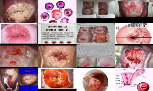 汕头宫颈糜烂的症状及图片
