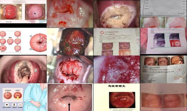 汕头宫颈炎图片