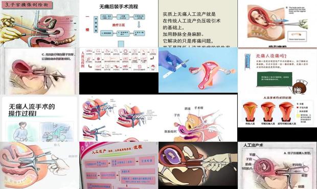 无痛人流汕头哪家医院好 - 汕头无痛人流图解