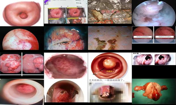 汕头宫颈长息肉