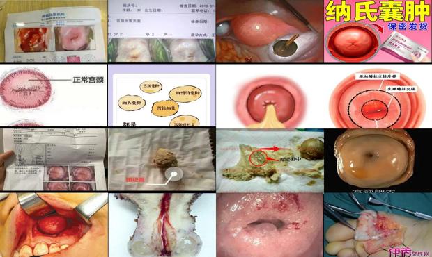 汕头宫颈多发纳囊