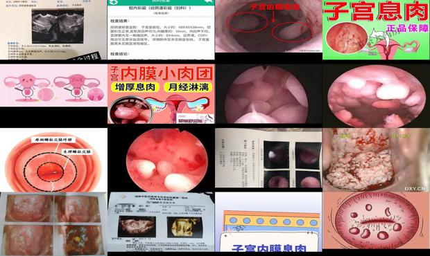 汕头宫颈上长息肉不切行吗