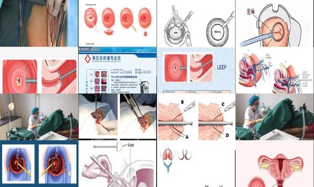 汕头宫颈利普刀手术过程图
