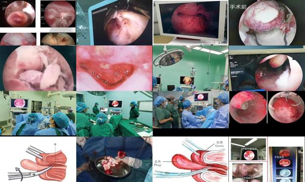 汕头宫颈息肉手术