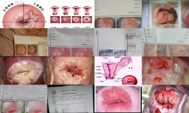 宫颈糜烂故事 - 汕头宫颈糜烂图片1至3度图片
